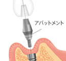 アバットメントイメージ