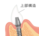 インプラント上部構造イメージ